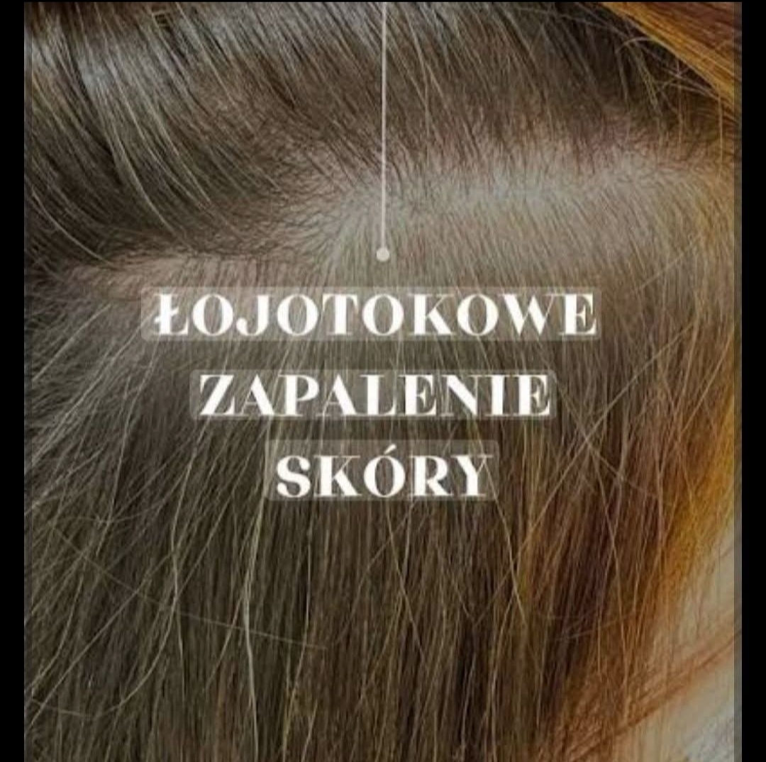 Read more about the article ŁZS – Łojotokowe zapalenie skóry